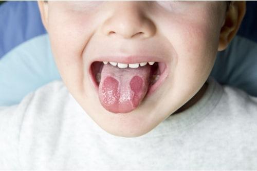 Stomatita pe limba