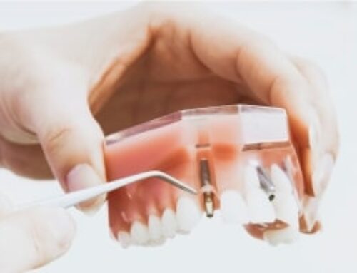 7 motive pentru implant dentar