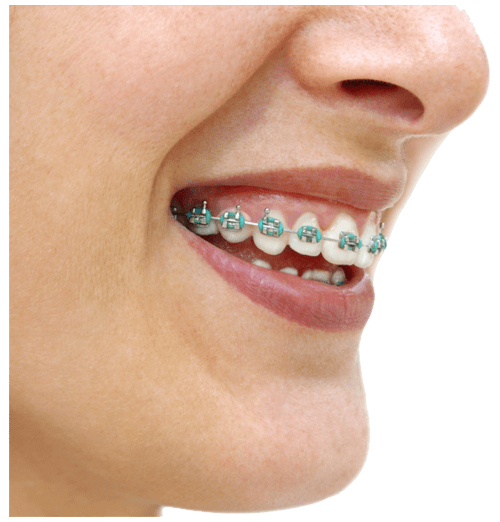 Ortodontie tg mures - aparat fix cu bracheti metalici