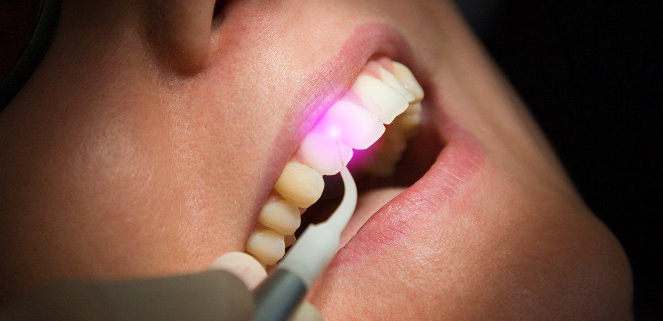 Laser dental - tratament laser DentaPoint