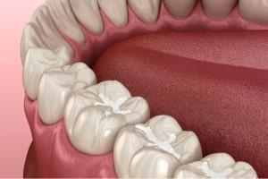 Sigilarea dintilor min